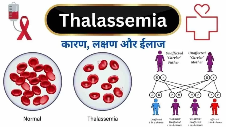 थैलेसीमिया बीमारी के संबंध में स्वास्थ्य विभाग ने दी जानकारी