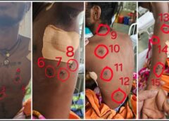 खून से लथपथ… फेफड़े फट चुके… सांसें थमने को थीं… 17 चाकू वार झेलने वाले युवक को सिम्स के डॉक्टरों ने मौत के मुंह से खींच लाया
