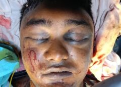 सांसें थमने से पहले सिम्स के डॉक्टरों ने रचा जीवन बचाने का चमत्कार: कटी श्वासनली, गले के गहरे घाव और गंभीर चोटों के बीच दो घंटे की हाई-रिस्क सर्जरी से 26 वर्षीय युवक को मिला नया जीवन