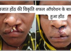 जन्मजात होंठ की विकृति से मिली नई जिंदगी: जिला अस्पताल बीजापुर में सफल सर्जरी के बाद भीमे हेमला के चेहरे पर लौटी मुस्कान