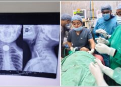 मौत के मुहाने से लौट आया 6 वर्षीय मासूम: सिम्स बिलासपुर के विशेषज्ञ डॉक्टरों ने जटिल ऑपरेशन कर आहार नली में फंसा सिक्का निकाला, परिजनों ने कहा—मिली नई जिंदगी