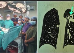 रायपुर मेडिकल कॉलेज का बड़ा कीर्तिमान! महज 20 दिनों में फेफड़ों की 9 जटिल सर्जरी, 15 साल के बच्चे का भी सफल ऑपरेशन