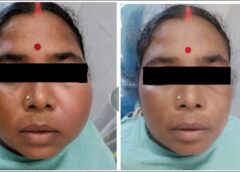पुरानी दांत की सड़न ने जबड़े में बना दी खतरनाक सिस्ट! सिम्स के डॉक्टरों ने आधुनिक तकनीक से बिना हड्डी को नुकसान पहुंचाए किया सफल इलाज